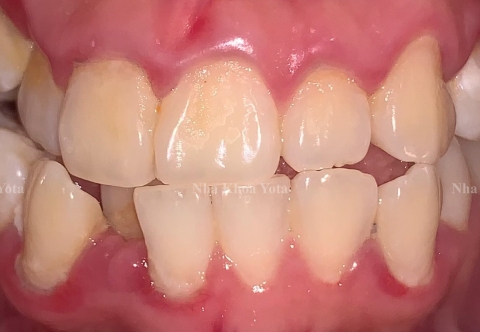 Răng khấp khểnh có nên niềng răng không